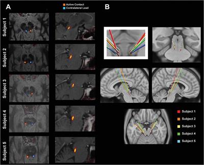 Neurophysiological Correlates of Gait in the Human Basal Ganglia and the PPN Region in Parkinson’s Disease